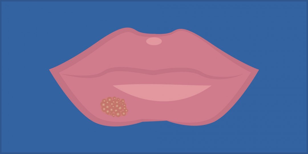 Illustration of Herpes on lips on blue background