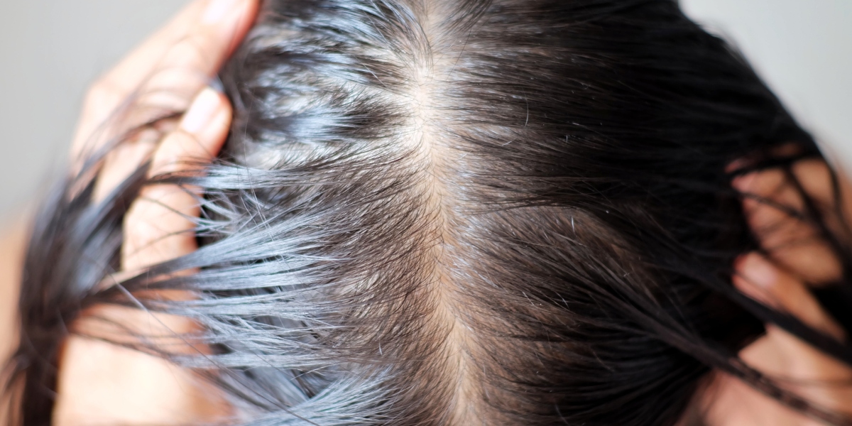 COVID patients are seeing excessive hair loss after infection