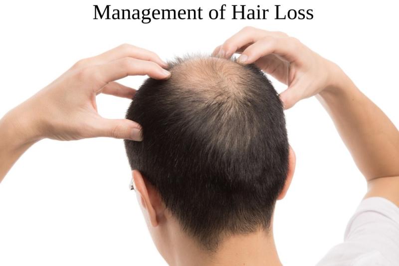 Management of Hair Loss