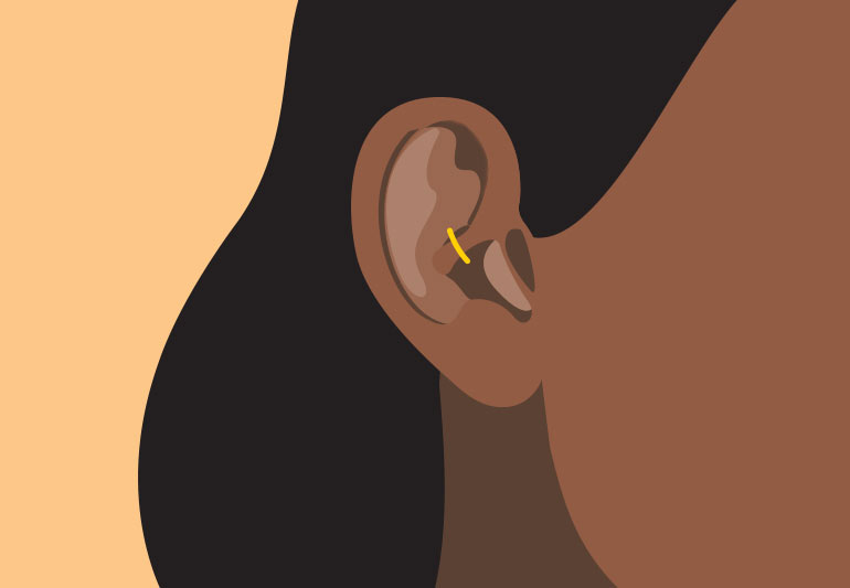 The Dangers of Ear Stapling