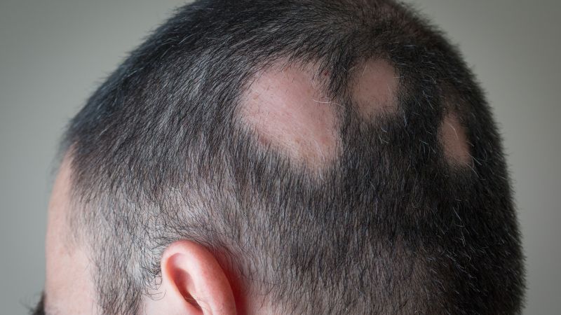 What causes alopecia, a 'devastating' hair loss condition affecting Jada Pinkett Smith | CNN