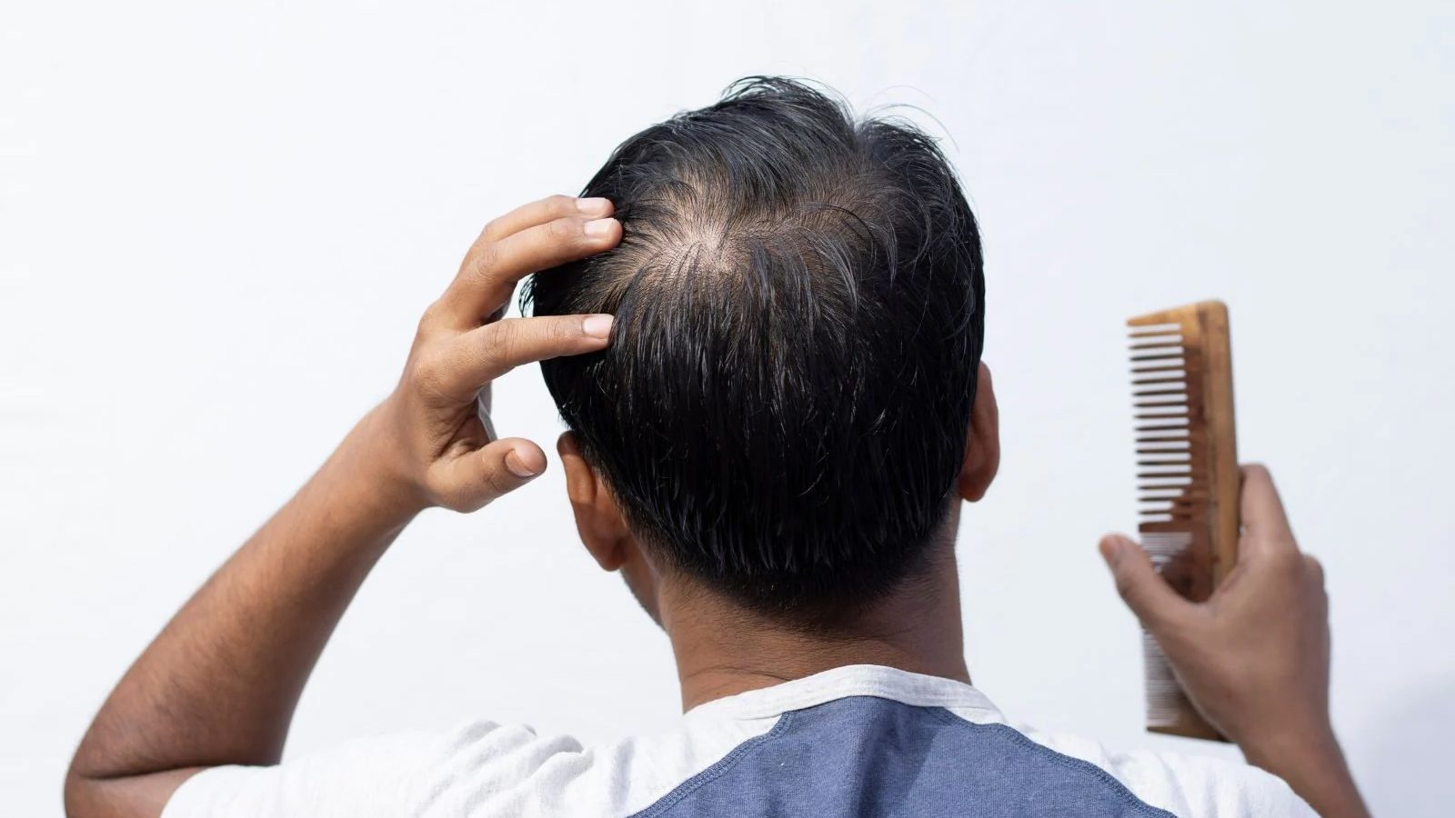 All You Need to Know About Hair Loss Causes, Prevention and Treatment