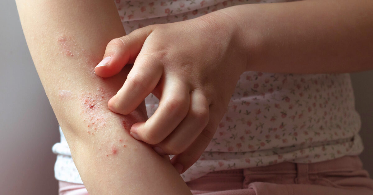 Betamethasone for Eczema: Use, Complications, Outlook