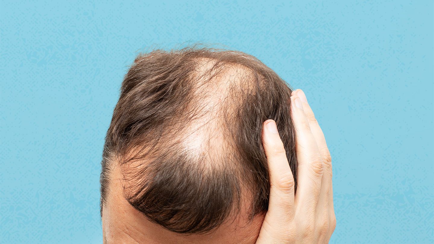 Causes and Risk Factors for Androgenetic Alopecia