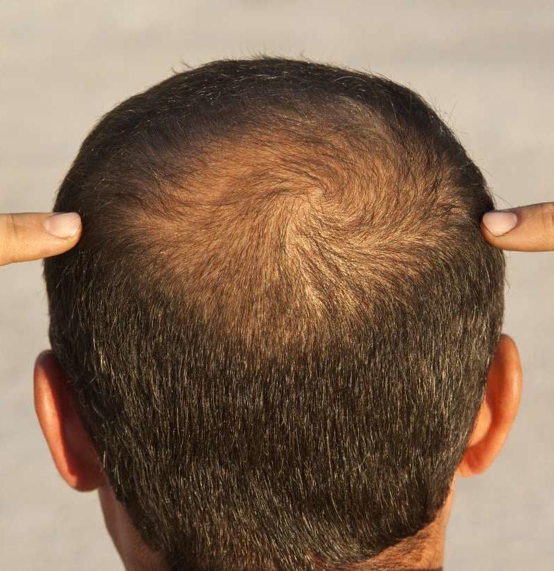Hair Loss and Growth Devices Market