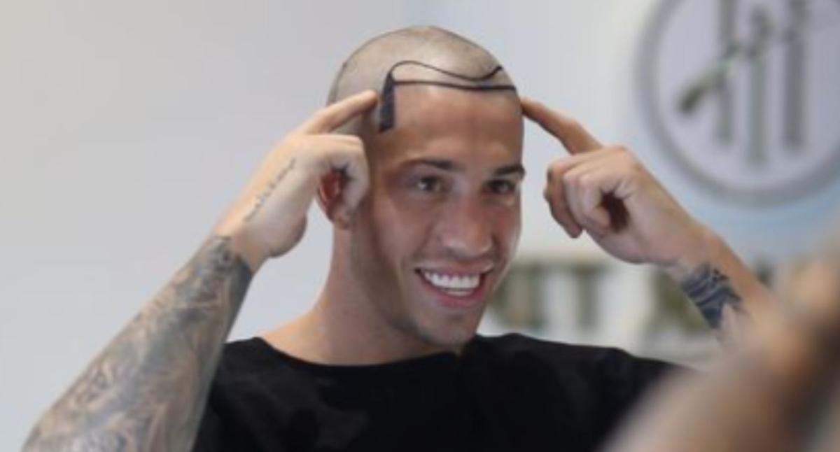 Love Island star Connor Durman gets hair transplant: 'I’ve been conscious of my hairline for a while'