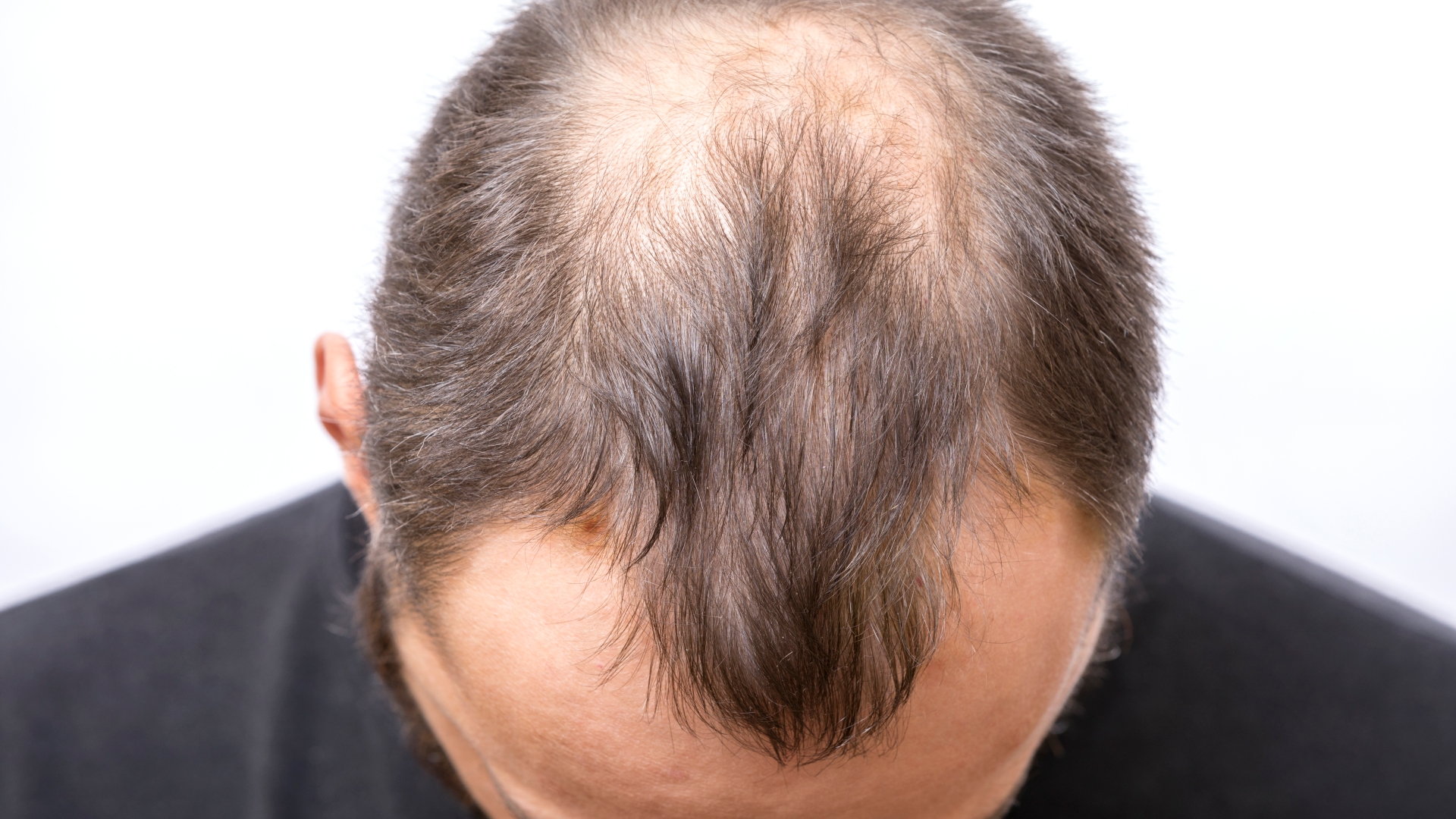 How a simple patch could help 'cure' baldness - giving hope to thousands