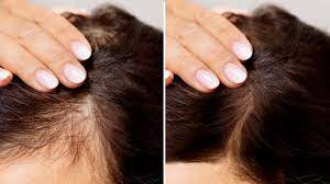 Hair Loss Treatment Market Forecast to 2028 : How it is Going to Impact on Global Industry to Grow in Near Future | Viviscal, Cipla Limited, Aclaris Therapeutics, Inc. - Digital Journal