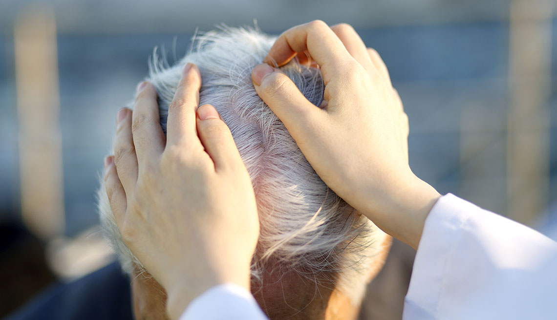 New Treatment for Hair Loss From Alopecia Areata