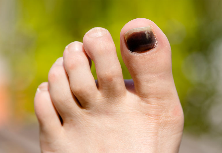 What To Know About Runner’s Toe