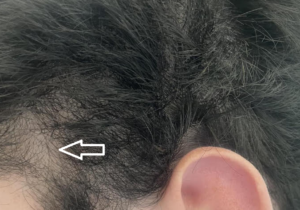 Possible Triangular Alopecia – WRassman,M.D. BaldingBlog